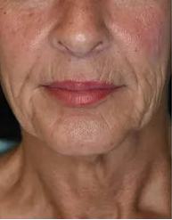 Antes